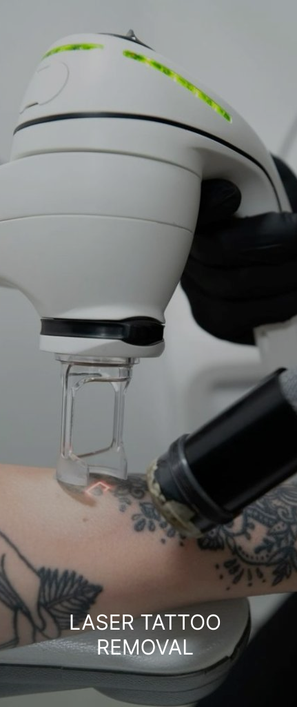 Laser tattoo removal procedure in a clinical setting, showcasing a handheld laser device targeting a tattoo on a person's arm.