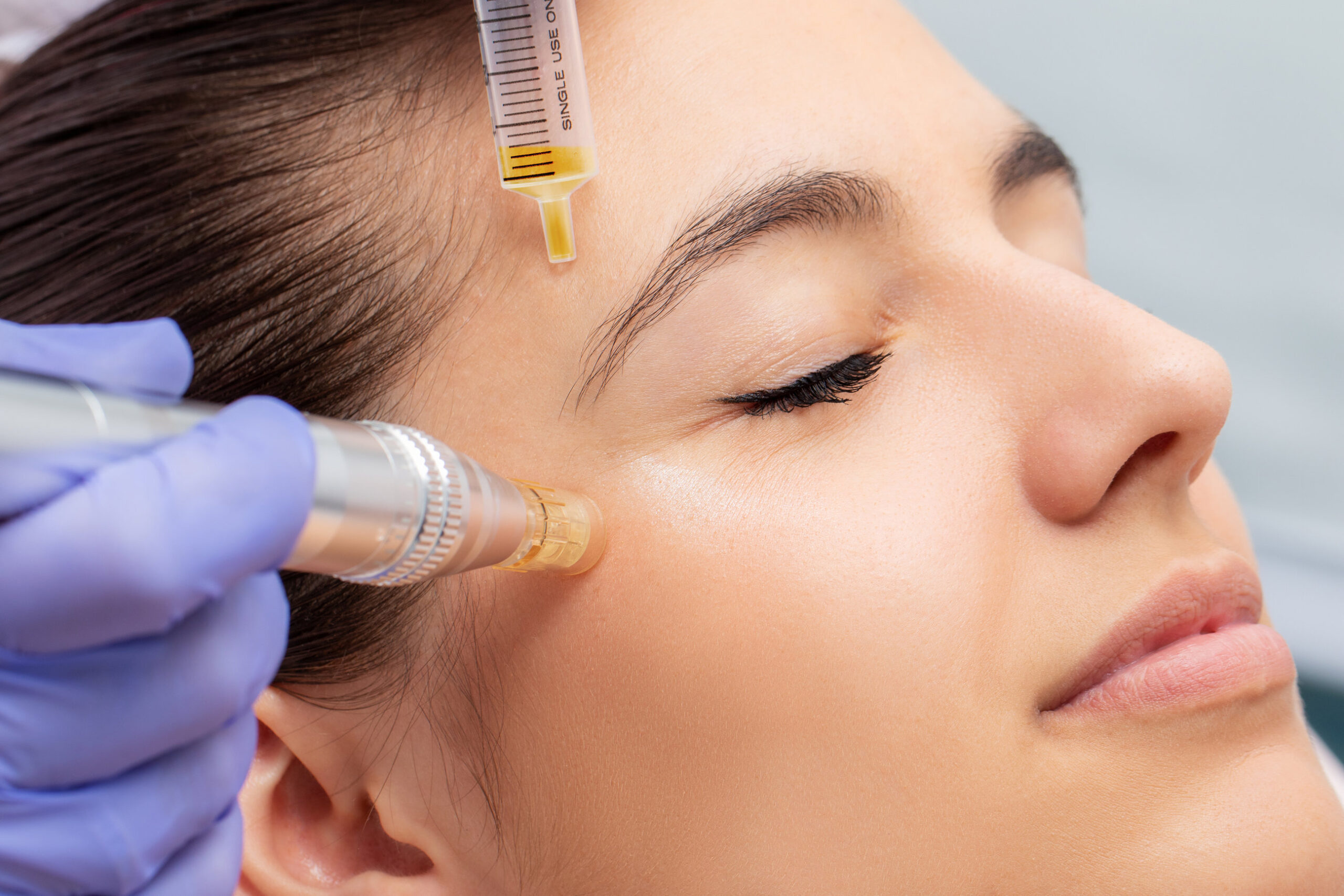PRPPRF with Microneedling