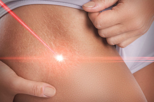 Laser Scar Removal for Stretch Marks: The New Gold Standard in 2025