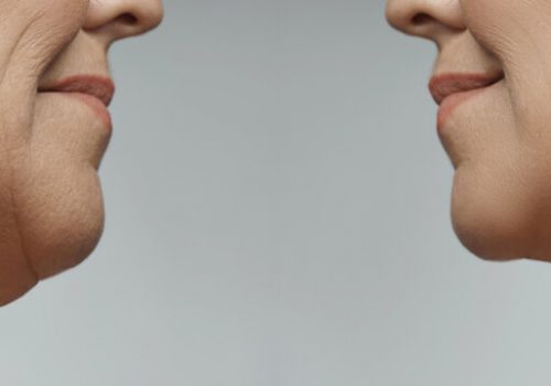 Best Double Chin Removal Treatments in Karachi: A Complete Guide