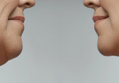 Double Chin Removal Treatment