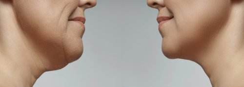 Double Chin Removal Treatment