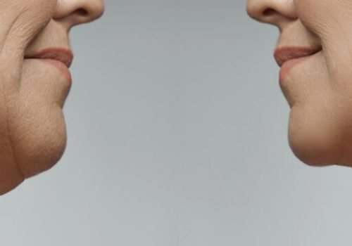 Double Chin Removal Treatment