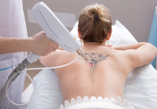 laser tattoo removal from back