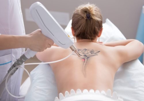 Laser tattoo removal being performed on a woman’s back.