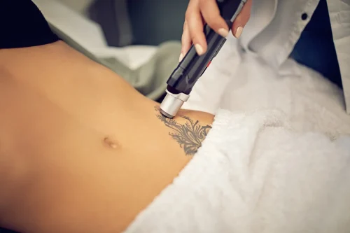 Laser tattoo removal treatment on a person’s abdomen.