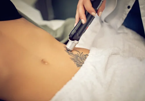Laser tattoo removal treatment on a person’s abdomen.