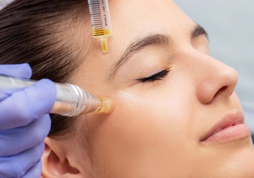 PRPPRF with Microneedling