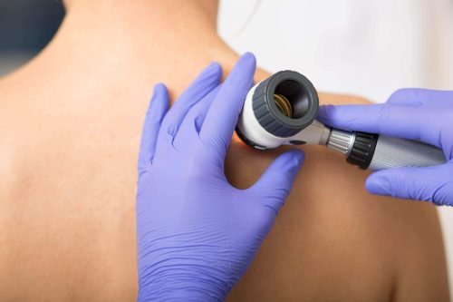 Dermatologist using a dermatoscope to examine a patient's skin.